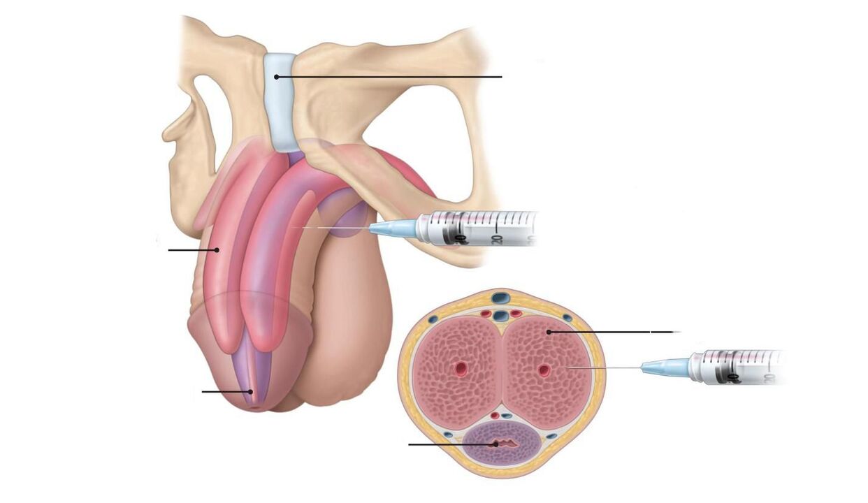 Penis enlargement injection