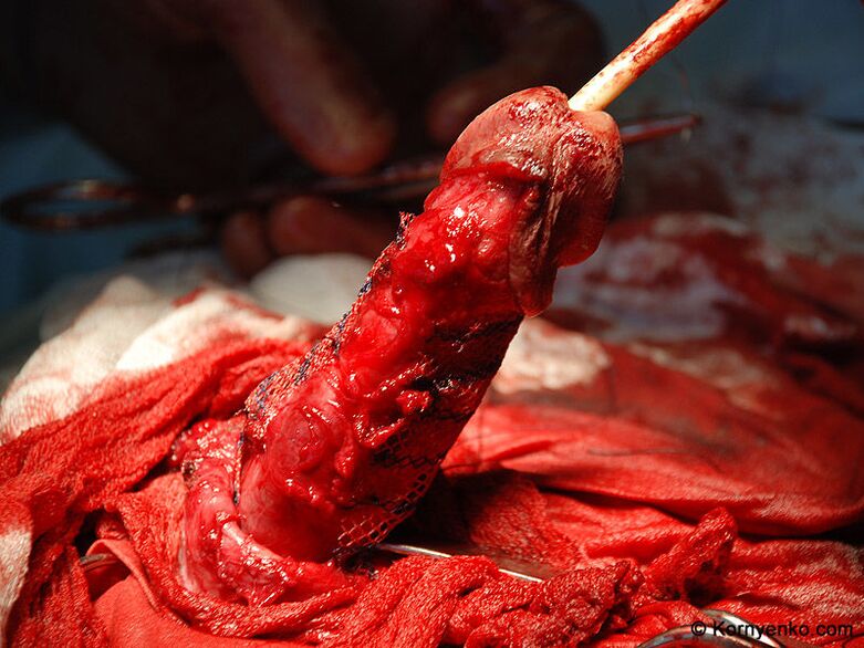 Install collagen matrix to enlarge penis