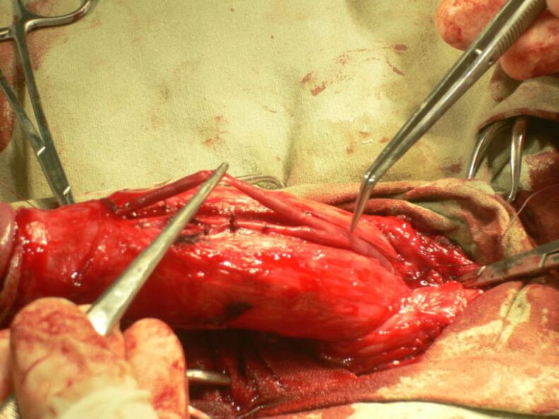 Penis fat filling for enlargement