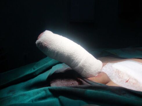 Bandaging the penis after enlargement surgery