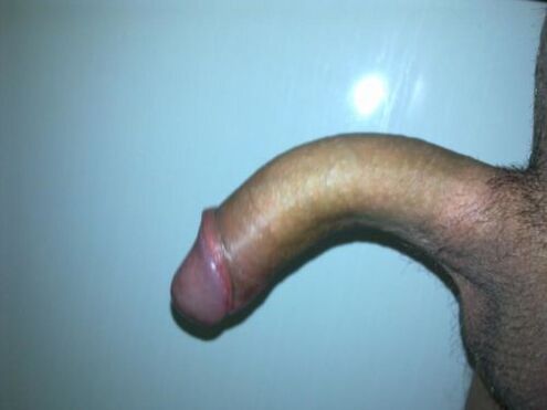 Penis curvature after enlargement surgery