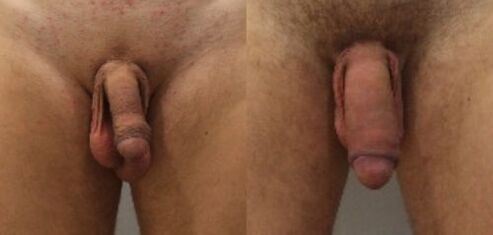 Penis enlargement surgery before and after