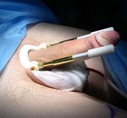 How is penis enlargement surgery performed