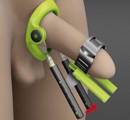 Recovery after penis enlargement surgery
